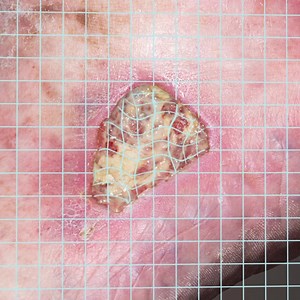 Managing exudate is central to moist wound care. In this regard,...