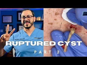 Infected back cyst part 2. Incision and lots of drainage.