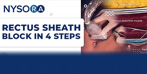 Rectus Sheath Block in 4 Steps - NYSORA