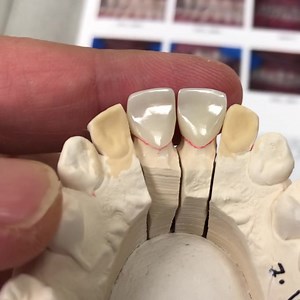 2-Unit Central Crowns with a Pure Zirconia Lingual Surface! | CEO Luke Kahng | Facebook
