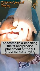 Complete 3D guided #ImplantSurgery . In this patient, we placed 3 implants using a computer guided stent with minimal discomfort. The guide helps us to do a non-invasive and highly precise surgery with predictable results. . Also the procedure is very comfortable for the patient with minimal pain or bleeding. The healing is faster as compared to a conventional free hand implant surgery. Finally, the post operative discomfort is minimal. . To know more visit www.drgargikandhari.com or call 997176