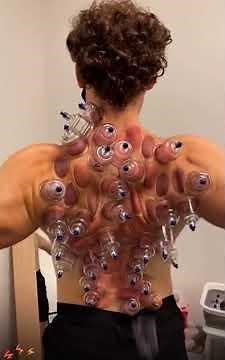 Pop Therapy #1 Satisfying pop noises back pop therapy