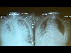 Ground-breaking surgery keeps woman alive without lungs