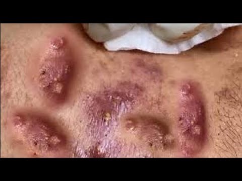 The Most Extreme Blackhead Popping Videos You've Ever Seen | acne | benzoyl peroxide | pimple