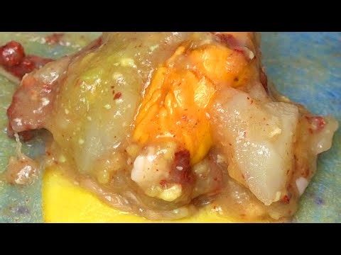 Dr. Lee 🌝 A Double Trouble Dilated Pore of Winer 🌝 Dr. Pimple Popper 🌝 261221