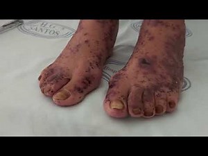 Leukocytoclastic Vasculitis