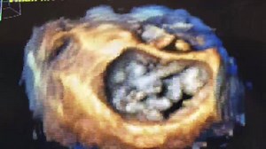 An example of the Vmax technology to enhance 3D echo on the GE Healthcare E95 system. The higher frame rate and better image reconstruction allows capture of a mitral valve flail that might otherwise be missed on lower frame rate 3D imaging. This was one of the new technologies GE highlighted at the American Society Of Echocardiography (ASE) 2018 meeting. #ASE2018 #ASE #ASE18 #echocardiography | Diagnostic and Interventional Cardiology - DAIC