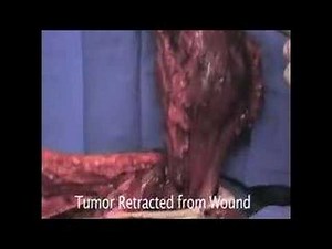 Distal End Femur Radical Excision 2/4 • Video • MEDtube.net