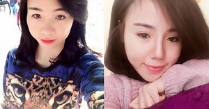 Khám phá sự khác biệt của nâng mũi Hàn Quốc “xưa và nay”