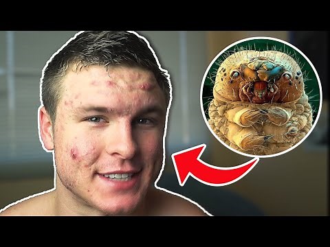 These Live On Your Face & Cause Acne! DEMODEX MITES!