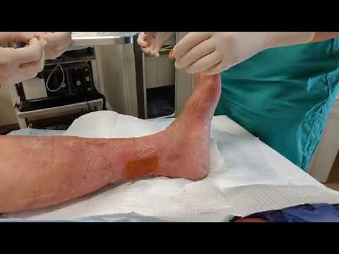 Venous Stasis Ulcer Bandaging and Dressing