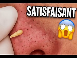 Soin de la peau/ Extraction d’énormes boutons et points noirs sur le visage (2025)