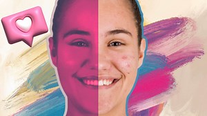 This Woman's Before/After Accutane Photos Have Gone Viral For Very Good Reason