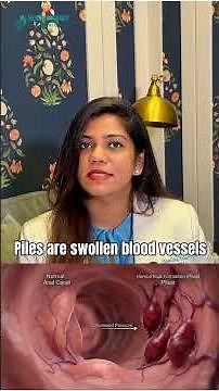 Rectal Prolapse Explained Simply: What’s Actually Coming Out?