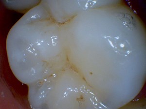 [Hot Item] Hot Sale MD740 USB Dental Intraoral Camera Health Care CMOS Wire Oral Cam