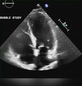 2.3K views · 53 reactions | Intra + Extra cardiac shunt | Cardiophilia | Facebook
