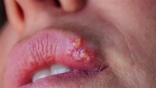 What Is A Cold Sore? Here's What Causes It