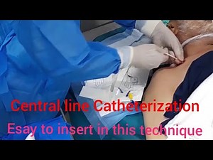 Central line Catheterization without ultrasound guide'Easy and simple insert of this technique