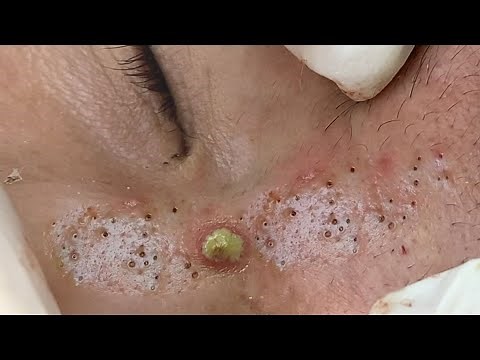 Suri Job #618: Awesome Blackheads Under Skin Extraction