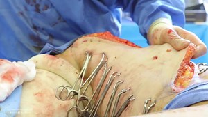 Revision of Medial Thigh Lift (GRAPHIC)