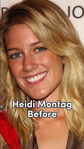 Heidi Montag Before And After Surgery || #celebrity #beforeandafter #model