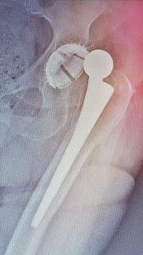 Posterior Hip Dislocation - Reduction Maneuver