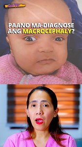 12K views · 50 reactions | Paano ma diagnose ang MACROCEPHALY ? | Nurse Yeza | Facebook