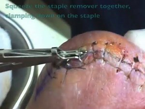 FAANT Removing Staples