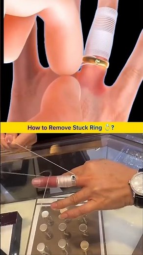Genius Trick to Remove a Stuck Ring Using String – Quick and Painless Ring Removal Hack!