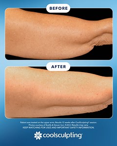 3.2K views | Stay cool with permanent fat elimination in the treated area! 流 CoolSculpting® is FDA-cleared to treat visible fat bulges, contouring 9 areas of the body. Learn more at the CoolSculpting.com. Keep watching for Uses and Important Safety Information. Intended for US Audiences Only. | CoolSculpting | Facebook