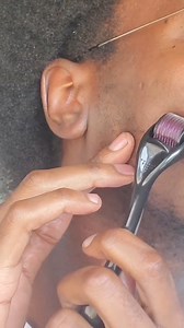 2.5K views · 13 reactions | How to use a derma roller Correctly  Note: the derma roller is effective for patchy beards, damaged hairline and also bald patches both in women and men. | Vero's Cosmetics | Facebook