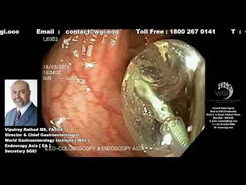 Endoscopic procedure of colonic balloon dilatation