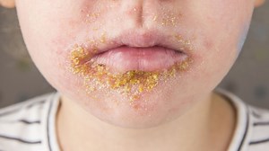 Impétigo : comment reconnaître cette infection de la peau très fréquente chez les enfants ? - RTBF Actus