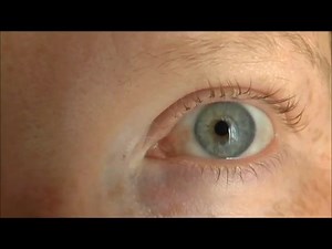 Episcleritis, a benign inflammatory eye condition, before and after treatment | Optometry Club