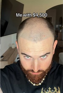 @HairNeva #hairtransplant | matt mask hair