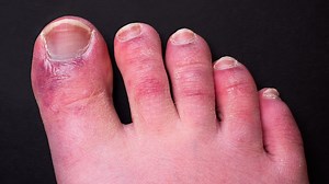 Scientists get to the bottom of why some people get nasty ‘Covid toes’