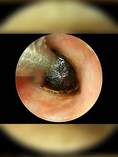 part-13 Ear cleaning asmr #cleaninghacks #cleaningasmr #cleaning #earwaxcleaning