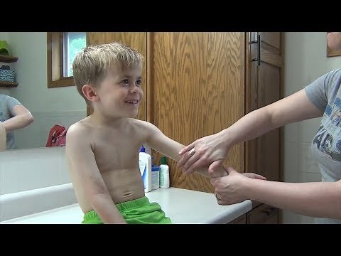 Mayo Clinic Minute: Understanding childhood eczema