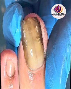 10K views · 68 reactions | Why You Should Regularly Protect Sensitive Nails Without Harsh Procedures #SafeNailCare #FootSupport #FootCareTips #ThickToenailCare | Alfonzo Feil | Facebook