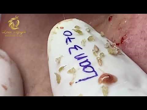 Blackheads removal and popping pimple (370) | Loan Nguyen