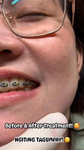 147K views · 536 reactions | #NGITINGTAGUMPAY#MAKEOVER#RIYADHKSA #qualitydenture #viralpost@highlight | Denture Denture | Facebook