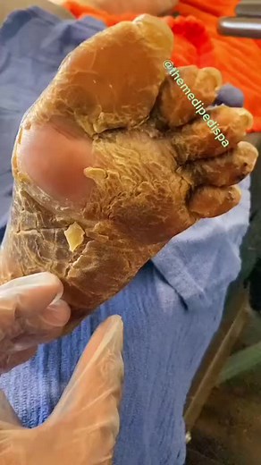 Biggest Pimples Compilation by Dr. Pimple Popper