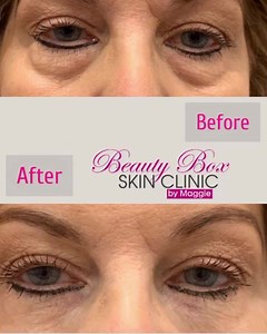 Tear trough filler  The goal of a tear trough filler is to reduce the depth of a tear trough. A trained professional injects a dermal filler into the area, making the skin look fuller and tighter. It’s a nonsurgical method of facial rejuvenation! Priced at only £150  for more enquires and bookings please contact us on 07424716505  | Skin Lab Beauty Clinic | Facebook