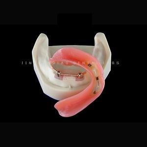 [Hot Item] Diseño de puentes móviles fijos de I-Bar para prótesis parciales Eliminación de ganchos no estéticos