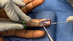 Finger VY Flap