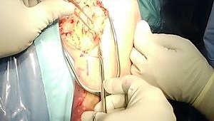 Lesser Tuberosity Osteotomy for Revision Shoulder Arthroplasty