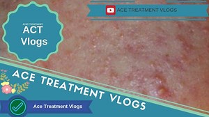 Series Acne Treatment Vlogs (Part 21) How to Get Rid of Blackheads &...
