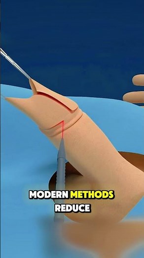 Circumcision Surgery Explained Simply (3D Animation)#medicaleducation #healthcare #fyp