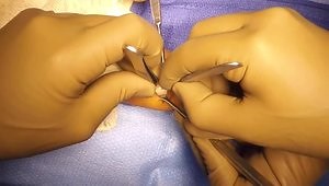 First Extensor Compartment Release for deQuervains Tenosynovitis