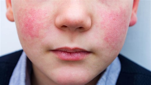 ‘Slapped cheek’ disease spreading as children break out in agonizing rash